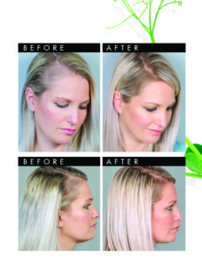 Pr Before After Aob (2)